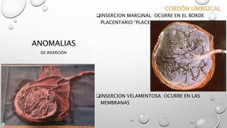 ANOMALIAS
DE INSERCIÓN
INSERCION MARGINAL: OCURRE EN EL BORDE
PLACENTARIO “PLACENTA EN RAQUETA”
INSERCION VELAMENTOSA: OCURRE EN LAS
MEMBRANAS
 