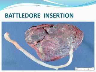 BATTLEDORE INSERTION
 