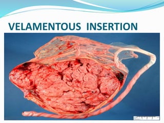 VELAMENTOUS INSERTION
 