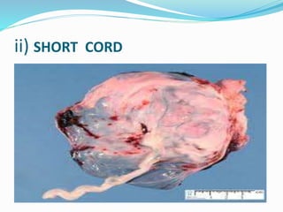 ii) SHORT CORD
 