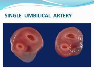 SINGLE UMBILICAL ARTERY
 
