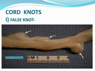 CORD KNOTS
I) FALSE KNOT-
 