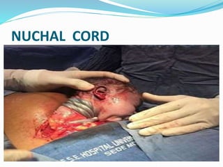 NUCHAL CORD
 
