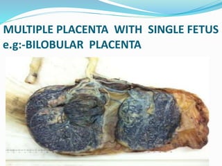MULTIPLE PLACENTA WITH SINGLE FETUS
e.g:-BILOBULAR PLACENTA
 
