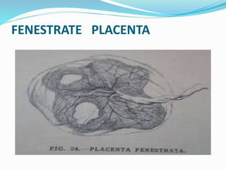 FENESTRATE PLACENTA
 