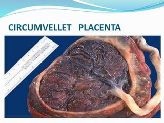 CIRCUMVELLET PLACENTA
 