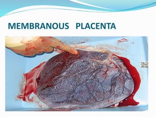 MEMBRANOUS PLACENTA
 