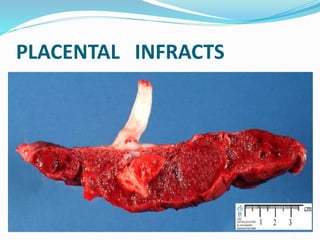 PLACENTAL INFRACTS
 