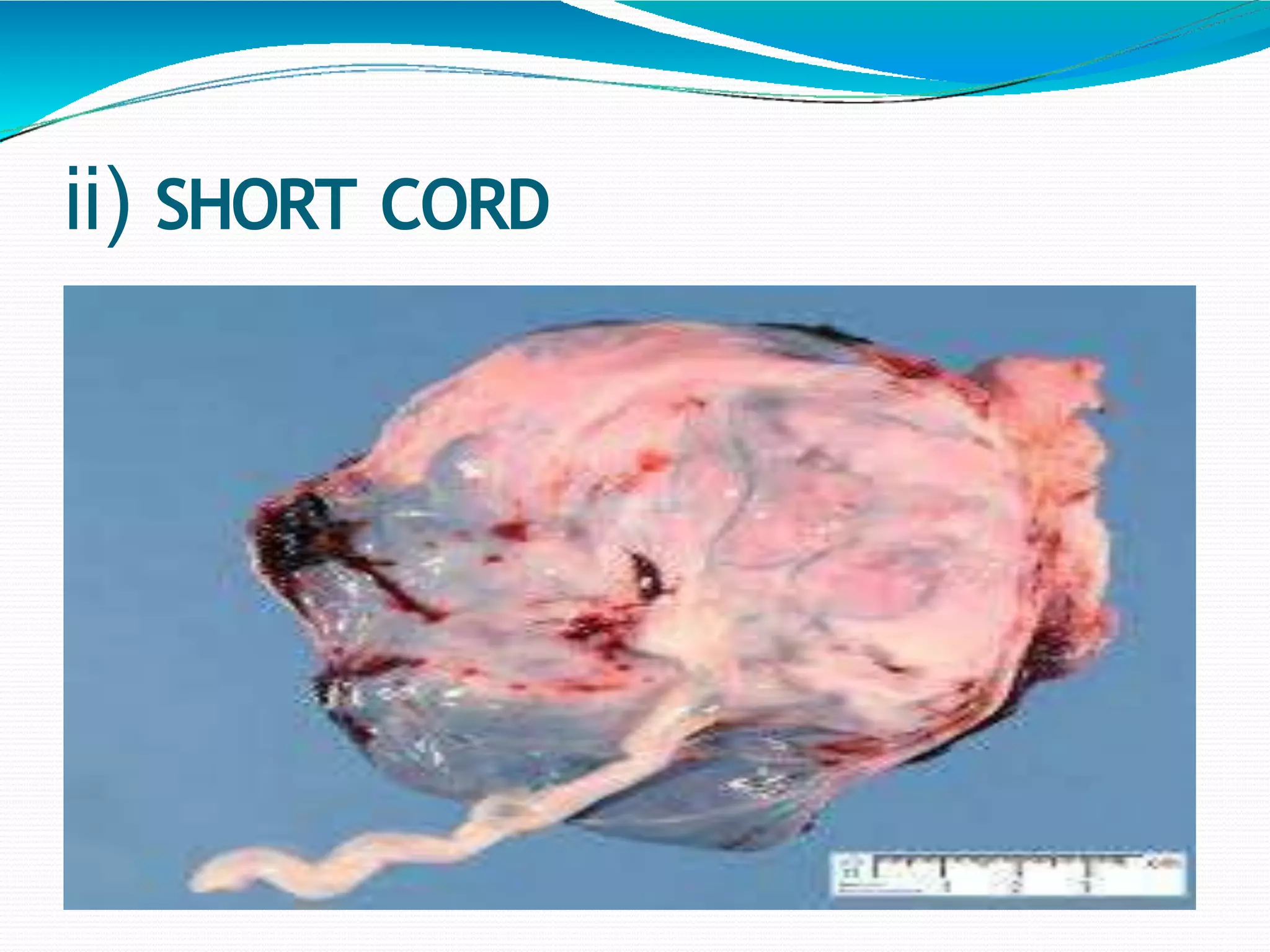 Placenta And Cord Abnormality