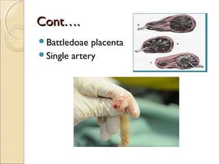 Cont….Cont….
Battledoae placenta
Single artery
 
