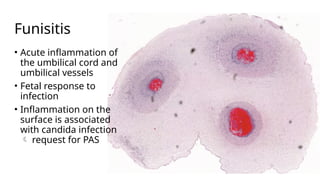 Funisitis Placenta and Gestational Trophoblastic Disease Lecture.pptx