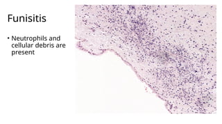 Funisitis Placenta and Gestational Trophoblastic Disease Lecture.pptx