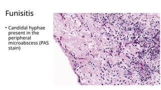 Funisitis Placenta and Gestational Trophoblastic Disease Lecture.pptx