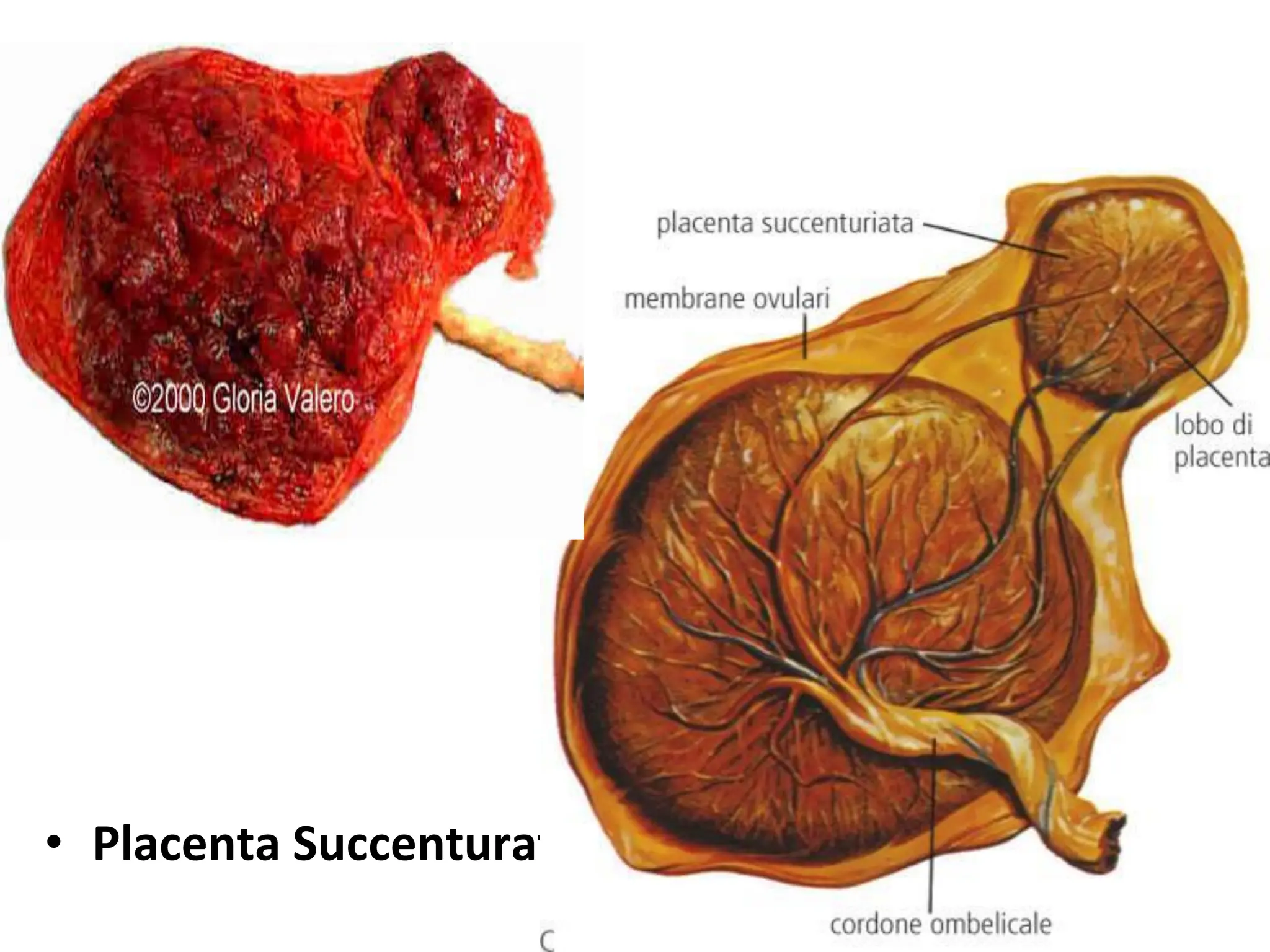 • Placenta Succenturata
 