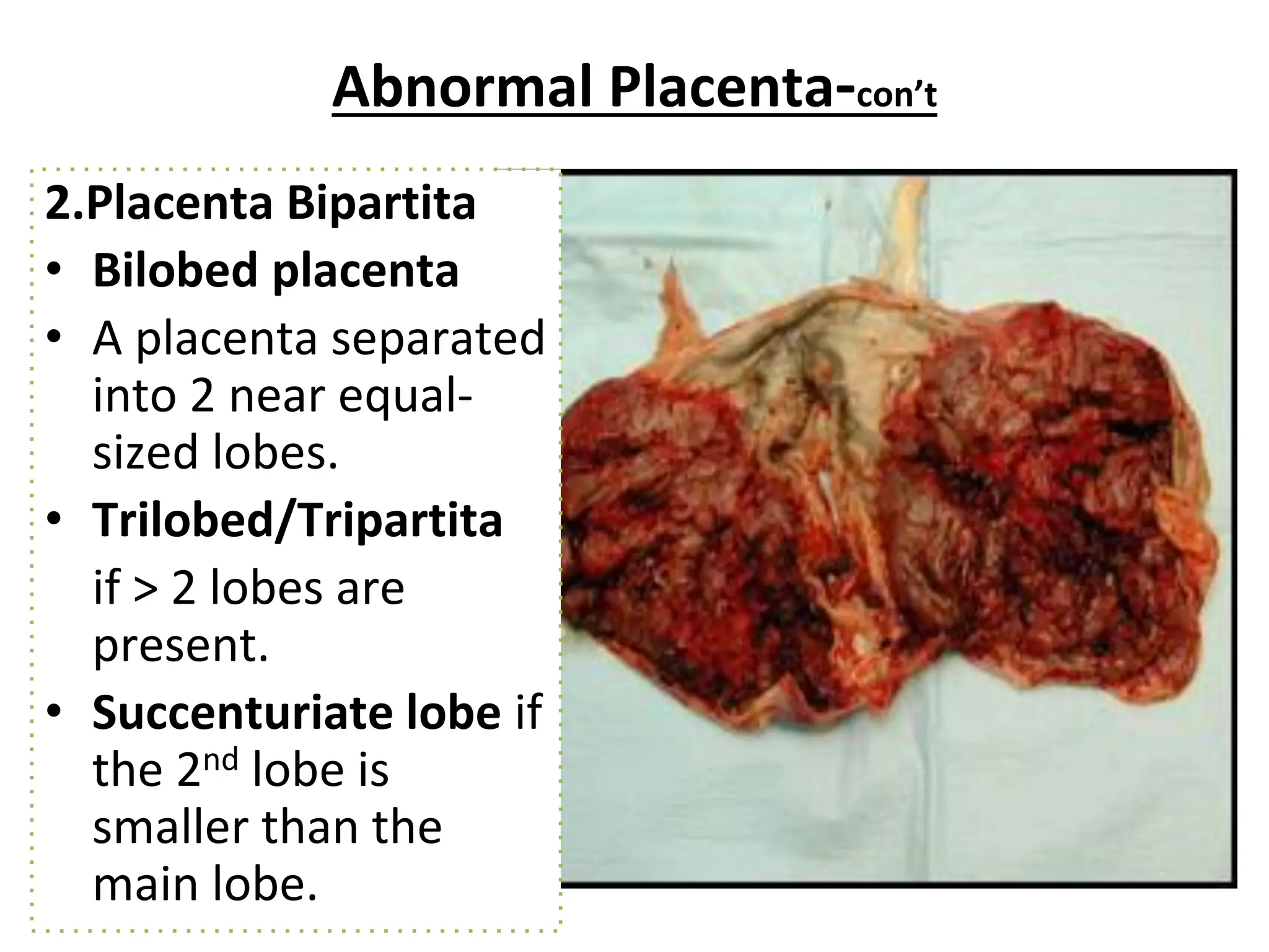 Abnormal Placenta-con’t
2.Placenta Bipartita
• Bilobed placenta
• A placenta separated
into 2 near equal-
sized lobes.
• Trilobed/Tripartita
if > 2 lobes are
present.
• Succenturiate lobe if
the 2nd lobe is
smaller than the
main lobe.
 