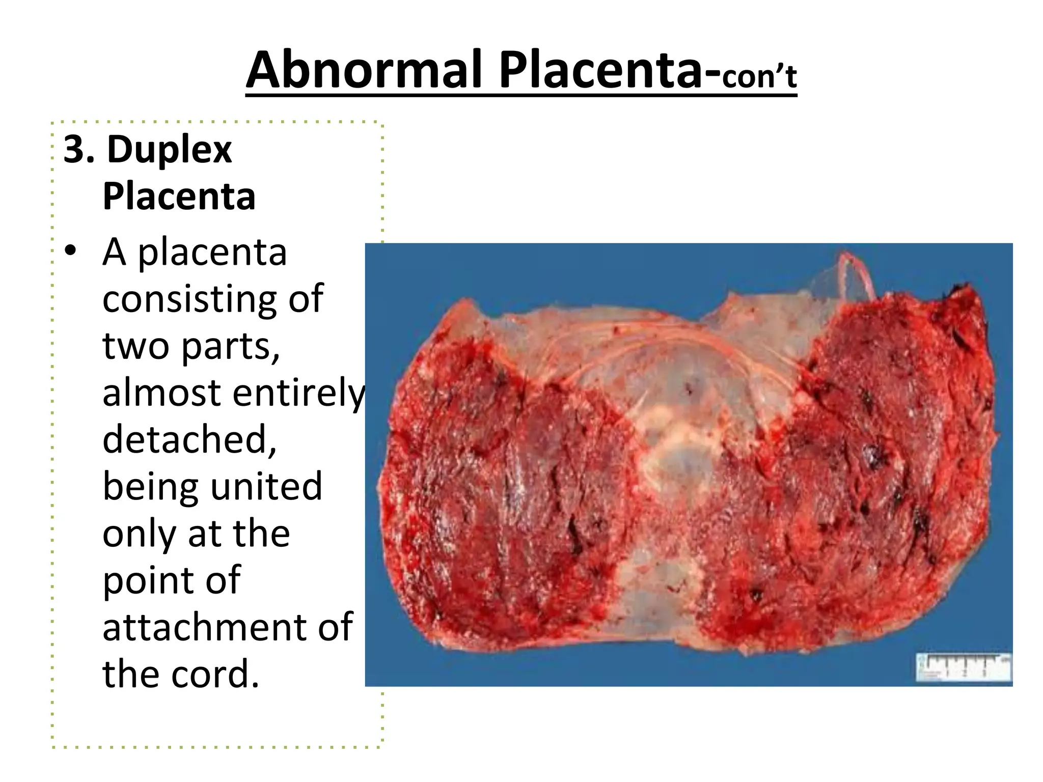 Abnormal Placenta-con’t
3. Duplex
Placenta
• A placenta
consisting of
two parts,
almost entirely
detached,
being united
only at the
point of
attachment of
the cord.
 