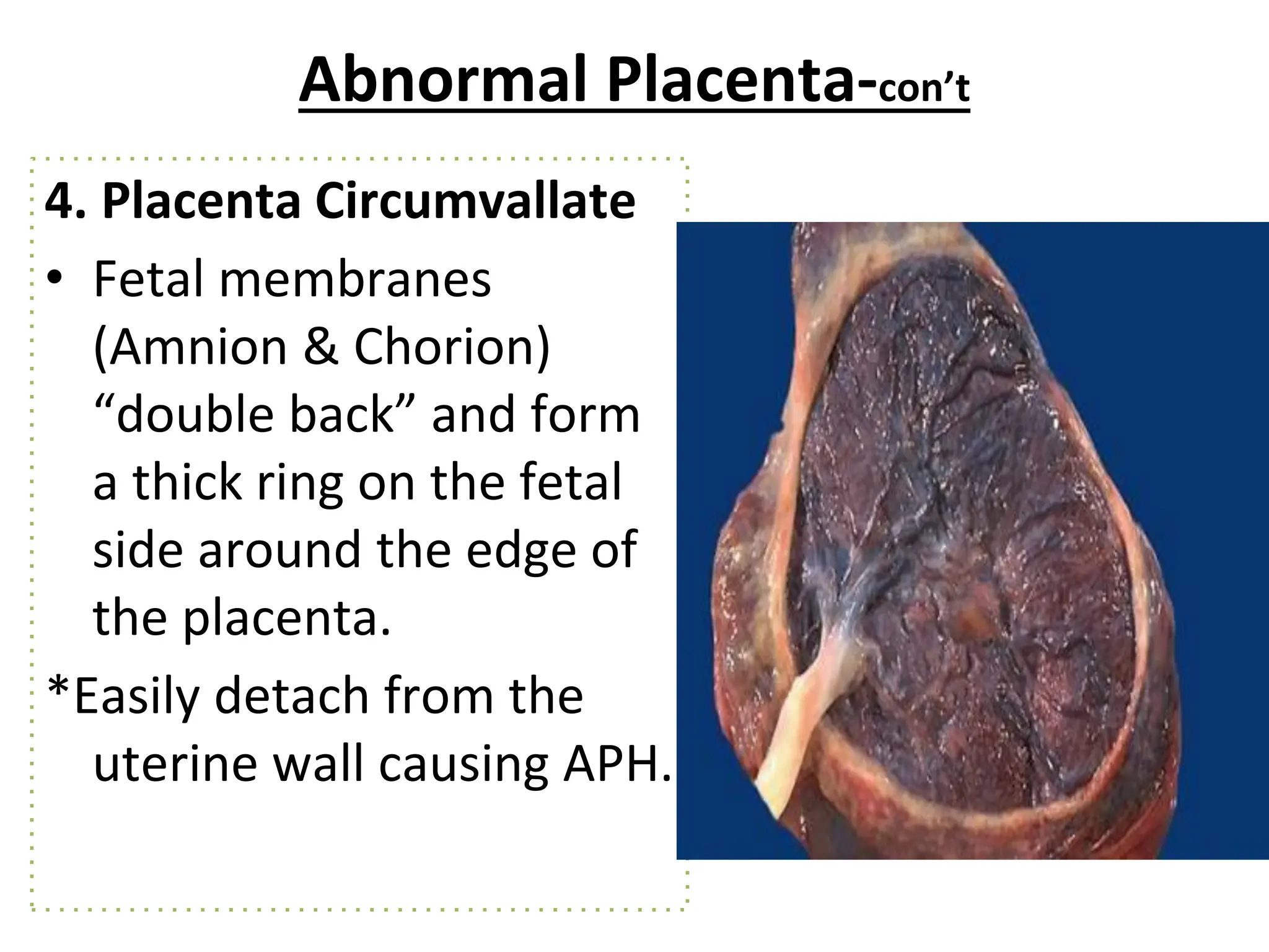 Abnormal Placenta-con’t
4. Placenta Circumvallate
• Fetal membranes
(Amnion & Chorion)
“double back” and form
a thick ring on the fetal
side around the edge of
the placenta.
*Easily detach from the
uterine wall causing APH.
 