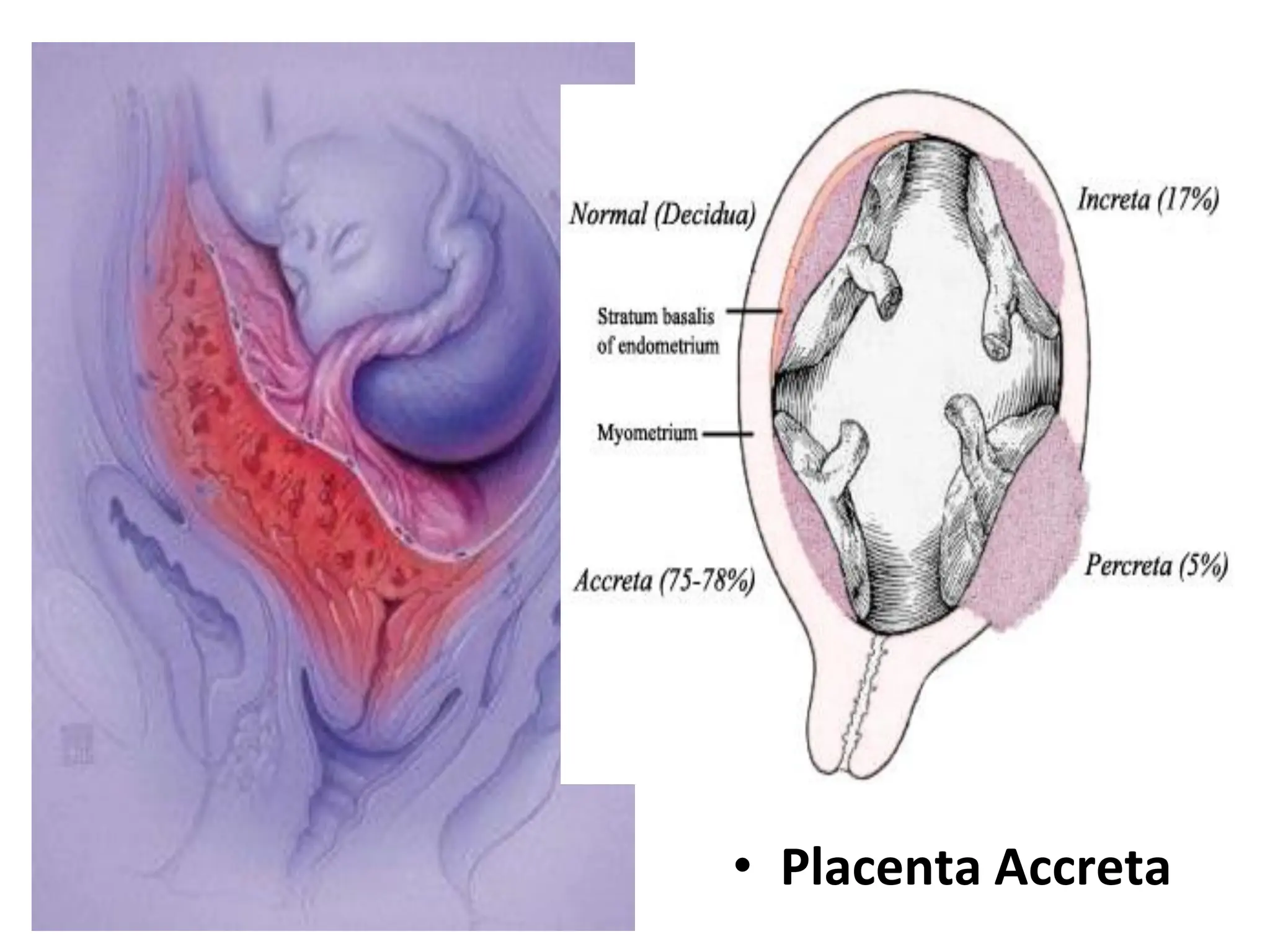 • Placenta Accreta
 