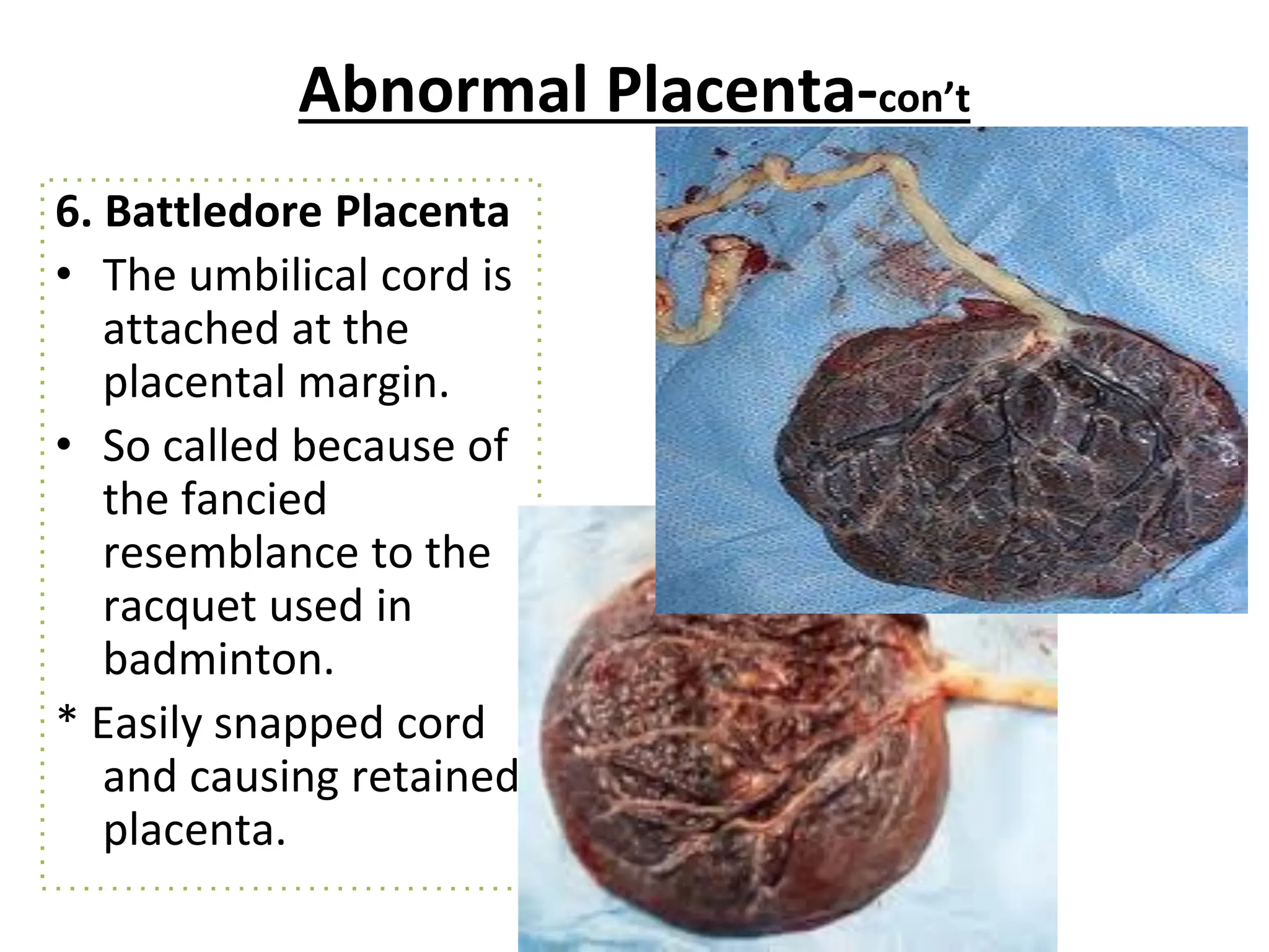Abnormal Placenta-con’t
6. Battledore Placenta
• The umbilical cord is
attached at the
placental margin.
• So called because of
the fancied
resemblance to the
racquet used in
badminton.
* Easily snapped cord
and causing retained
placenta.
 