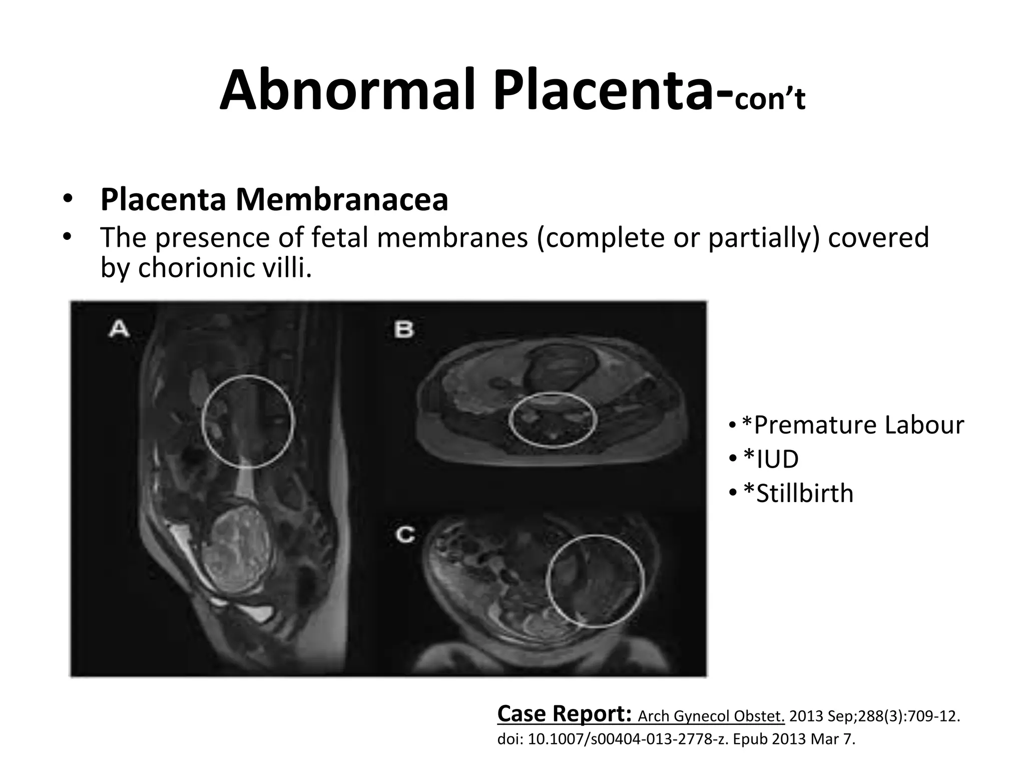 Abnormal Placenta-con’t
• Placenta Membranacea
• The presence of fetal membranes (complete or partially) covered
by chorionic villi.
Case Report: Arch Gynecol Obstet. 2013 Sep;288(3):709-12.
doi: 10.1007/s00404-013-2778-z. Epub 2013 Mar 7.
• *Premature Labour
•*IUD
•*Stillbirth
 