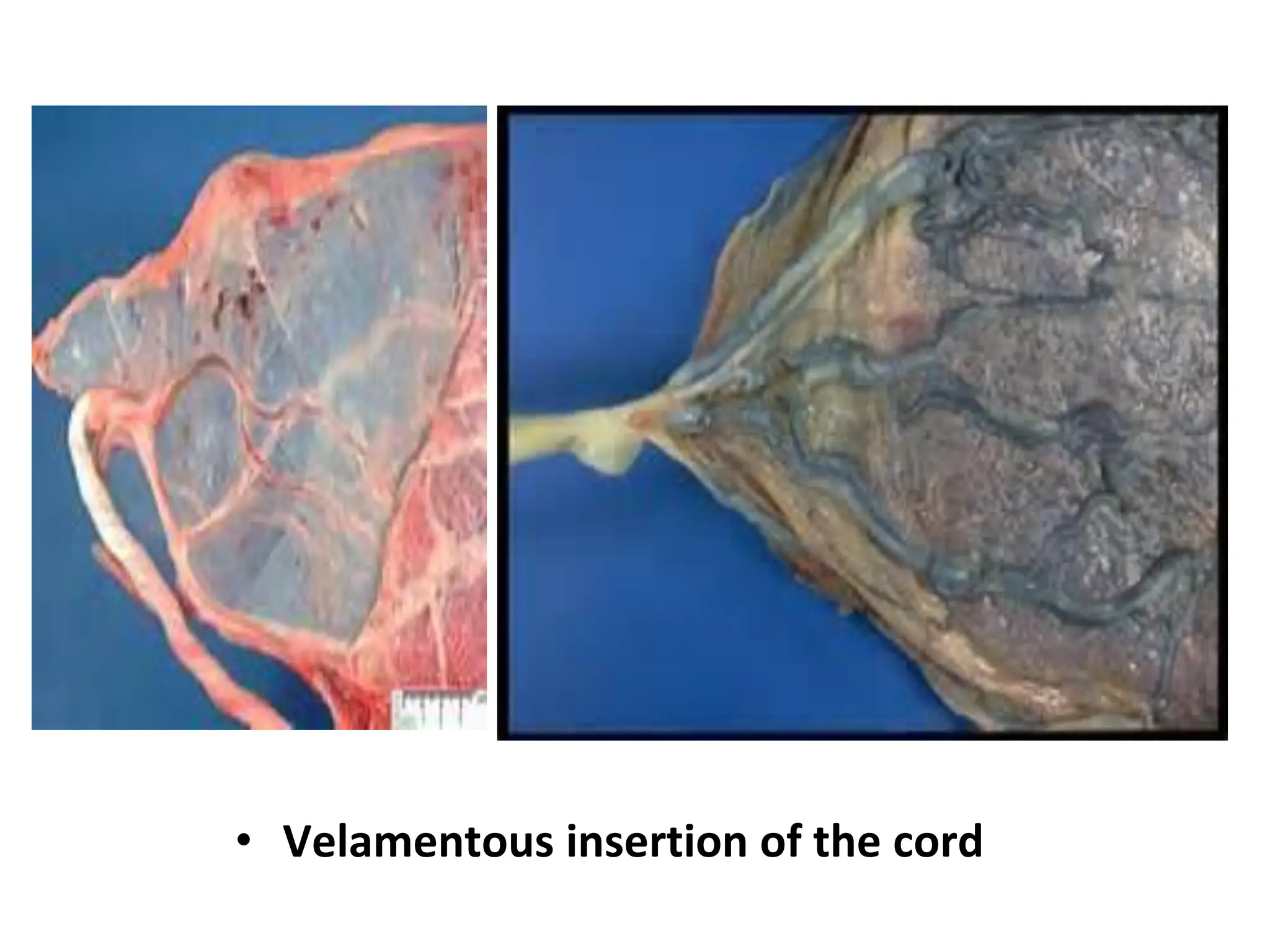 • Velamentous insertion of the cord
 