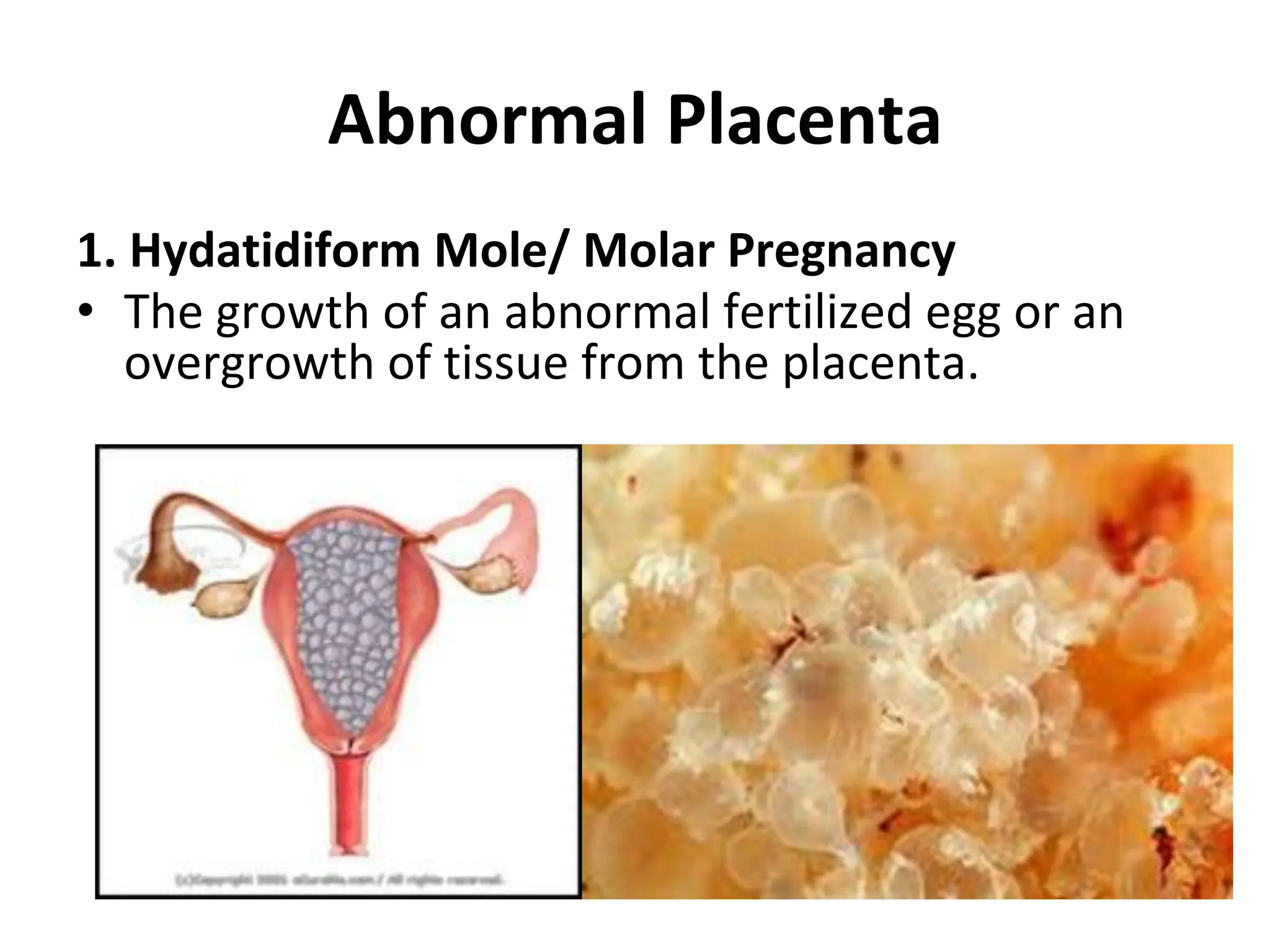 Abnormal Placenta
1. Hydatidiform Mole/ Molar Pregnancy
• The growth of an abnormal fertilized egg or an
overgrowth of tissue from the placenta.
 