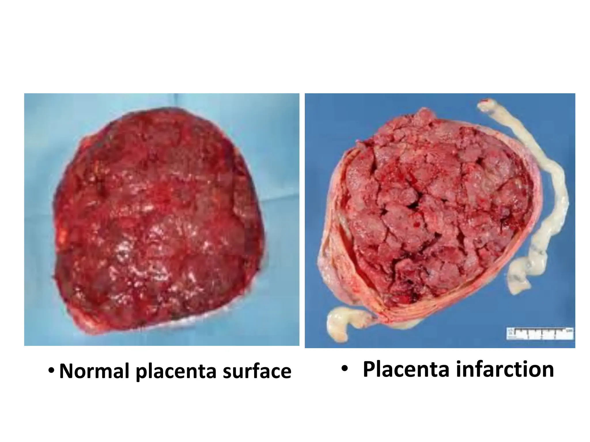 • Placenta infarction
• Normal placenta surface
 