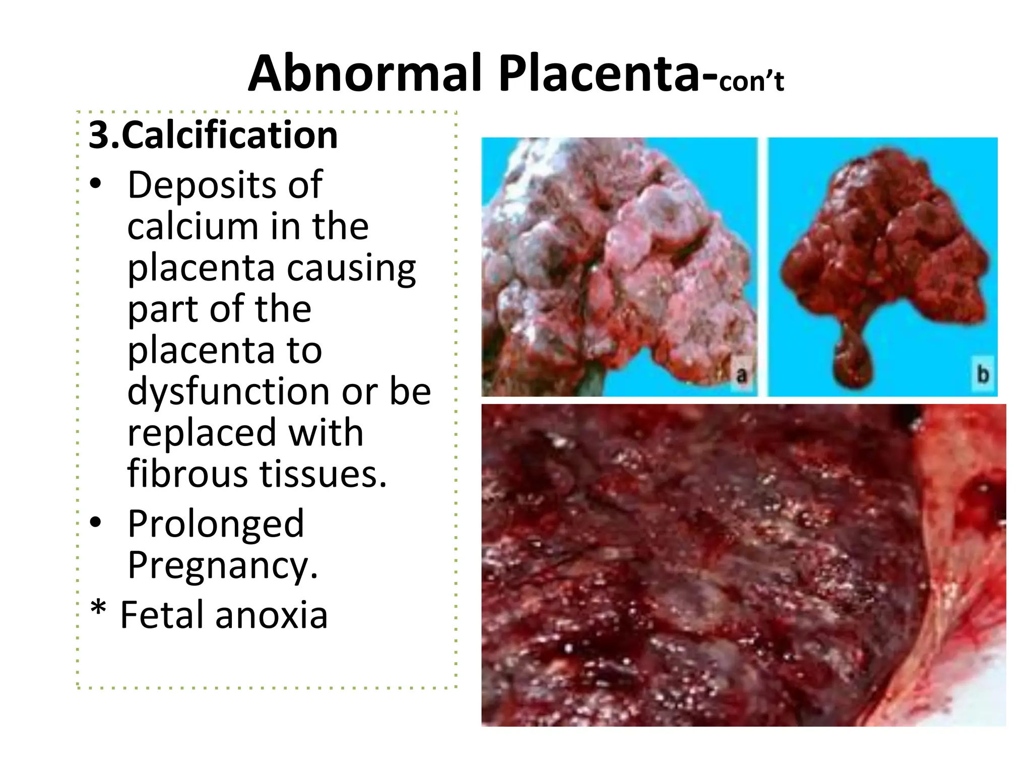 Abnormal Placenta-con’t
3.Calcification
• Deposits of
calcium in the
placenta causing
part of the
placenta to
dysfunction or be
replaced with
fibrous tissues.
• Prolonged
Pregnancy.
* Fetal anoxia
 