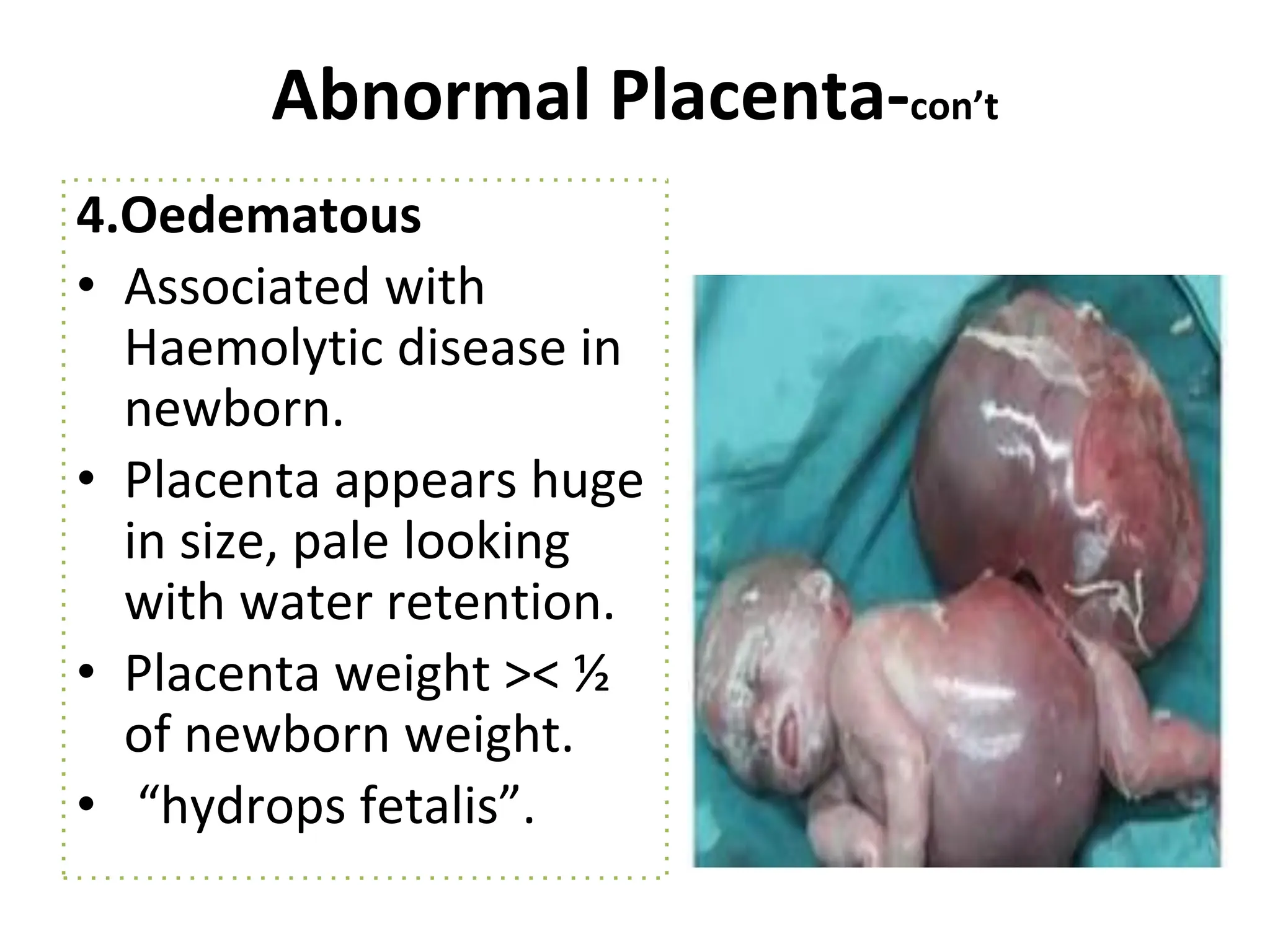 Abnormal Placenta-con’t
4.Oedematous
• Associated with
Haemolytic disease in
newborn.
• Placenta appears huge
in size, pale looking
with water retention.
• Placenta weight >< ½
of newborn weight.
• “hydrops fetalis”.
 