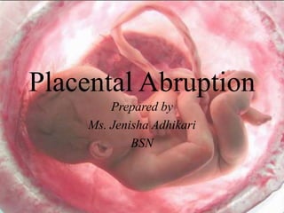 Placental Abruption
Prepared by
Ms. Jenisha Adhikari
BSN
 