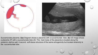 Succenturiate placenta. 2(a) Diagram shows a placenta with a succenturiate lobe. (b) US image shows
a placenta (P) with a succenturiate lobe (S). The main body of the placenta is located along the
posterior uterine wall. A second soft-tissue structure of the same echogenicity but located anteriorly is
the succenturiate lobe.
 