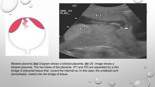 Bilobed placenta.3(a) Diagram shows a bilobed placenta. (b) US image shows a
bilobed placenta. The two lobes of the placenta (P1 and P2) are separated by a thin
bridge of placental tissue that covers the internal os. In this case, the umbilical cord
(arrowhead) inserts into the bridge of tissue.
 