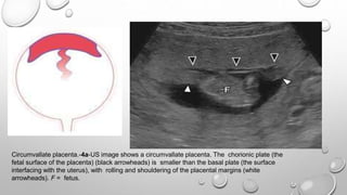 Circumvallate placenta.-4a-US image shows a circumvallate placenta. The chorionic plate (the
fetal surface of the placenta) (black arrowheads) is smaller than the basal plate (the surface
interfacing with the uterus), with rolling and shouldering of the placental margins (white
arrowheads). F = fetus.
 