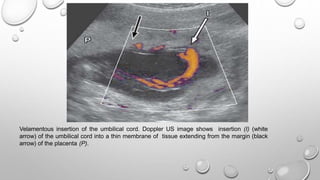 Velamentous insertion of the umbilical cord. Doppler US image shows insertion (I) (white
arrow) of the umbilical cord into a thin membrane of tissue extending from the margin (black
arrow) of the placenta (P).
 