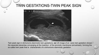 TWIN GESTATIONS-TWIN PEAK SIGN
Twin peak sign in dichorionic-diamniotic twin gestations. (a) US image of an early twin gestation shows
the separate placentas converging at the insertion of the amniotic membrane (arrowhead), forming the
so-called twin peak that is characteristic of a dichorionic-diamniotic gestation.
 