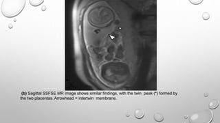 (b) Sagittal SSFSE MR image shows similar findings, with the twin peak (*) formed by
the two placentas. Arrowhead = intertwin membrane.
 