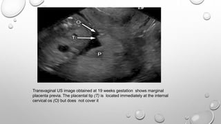 Transvaginal US image obtained at 19 weeks gestation shows marginal
placenta previa. The placental tip (T) is located immediately at the internal
cervical os (O) but does not cover it
 