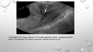 Transvaginal US image obtained at 19 weeks gestation shows complete placenta
previa. The placenta (P) entirely covers the internal cervical os (O).
 