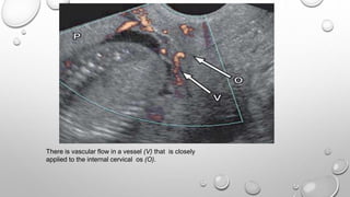 There is vascular flow in a vessel (V) that is closely
applied to the internal cervical os (O).
 