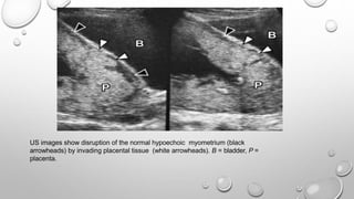 US images show disruption of the normal hypoechoic myometrium (black
arrowheads) by invading placental tissue (white arrowheads). B = bladder, P =
placenta.
 