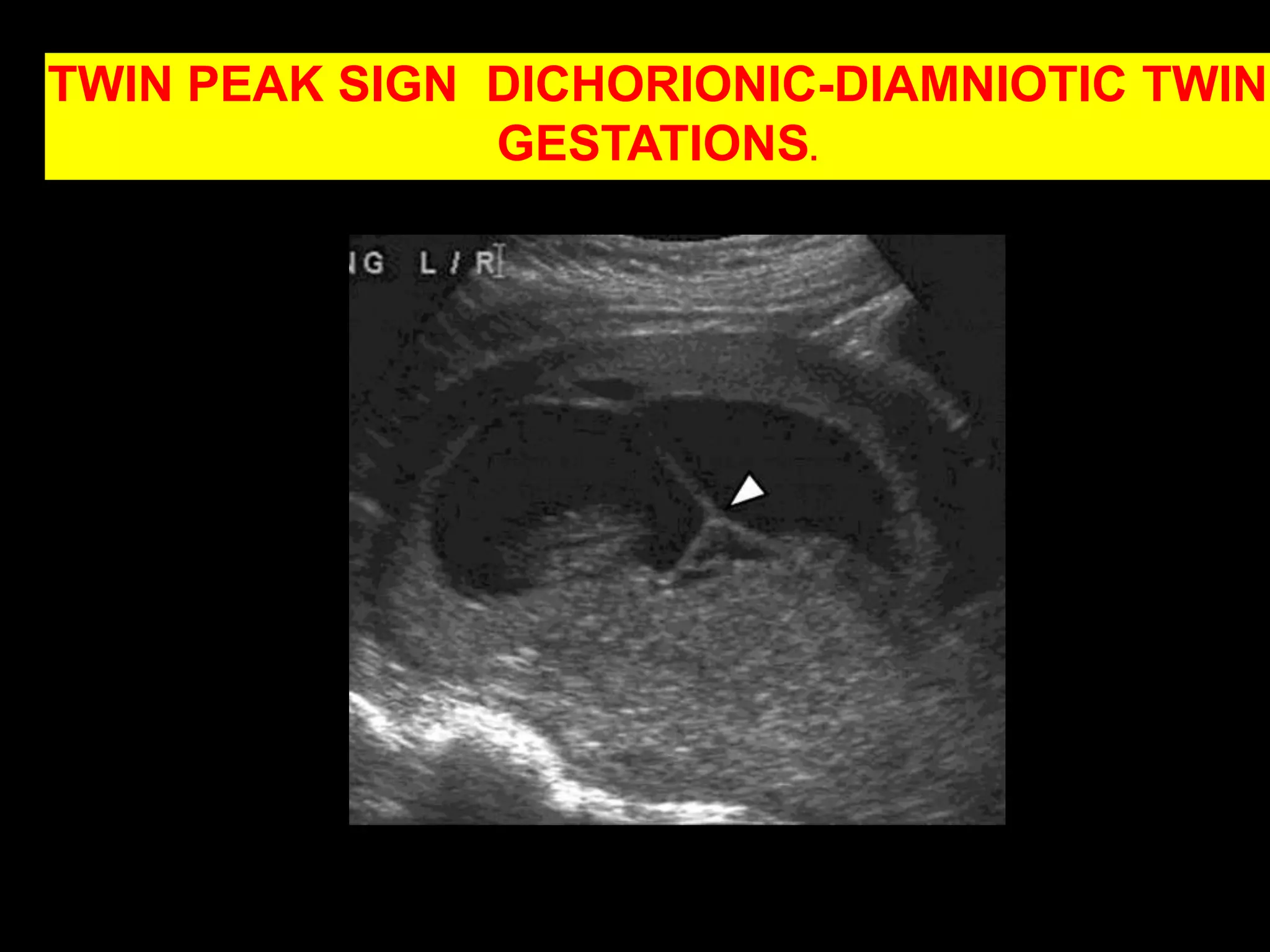 SUCCENTURATE  LOBE PLACENTASMALL LOBE SEPARATED FROM THE MAIN  PLACENTAL MASS.©2009 by Radiological Society of North America