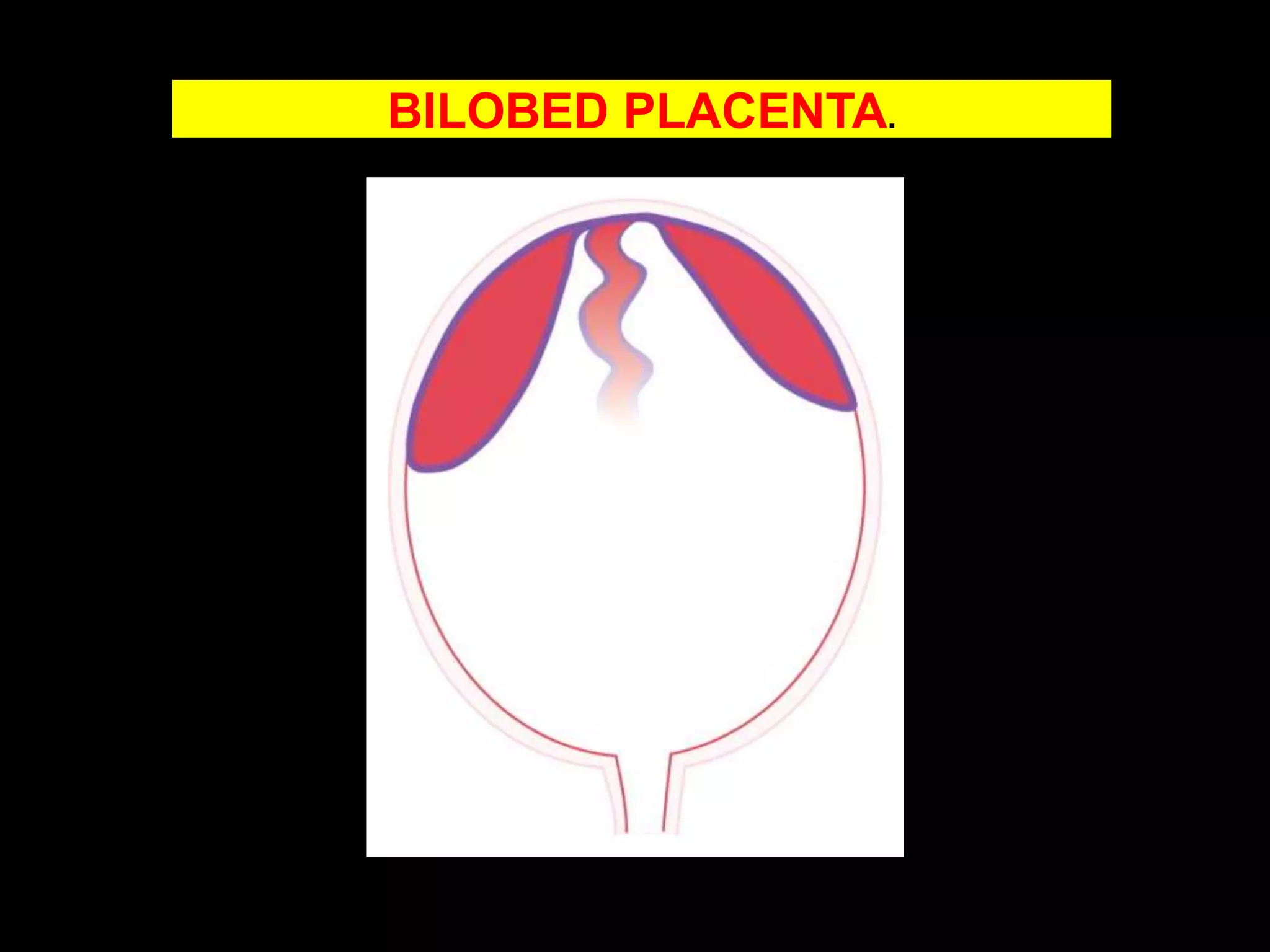 TWINNING- SOME RULES………..TWO  YOLK SACS TWO AMNIONTWO PLACENTA TWO CHORIONT SIGN – MONOCHORIONIC DIAMNIOTICTWIN BEAK SIGN- DIAMNIOTIC / DICHORIONICINTERTWIN MEMBERANE>2 MM ( DIAMNIOTIC / DICHORIONIC)<2 MM ( DIAMNIOTIC)