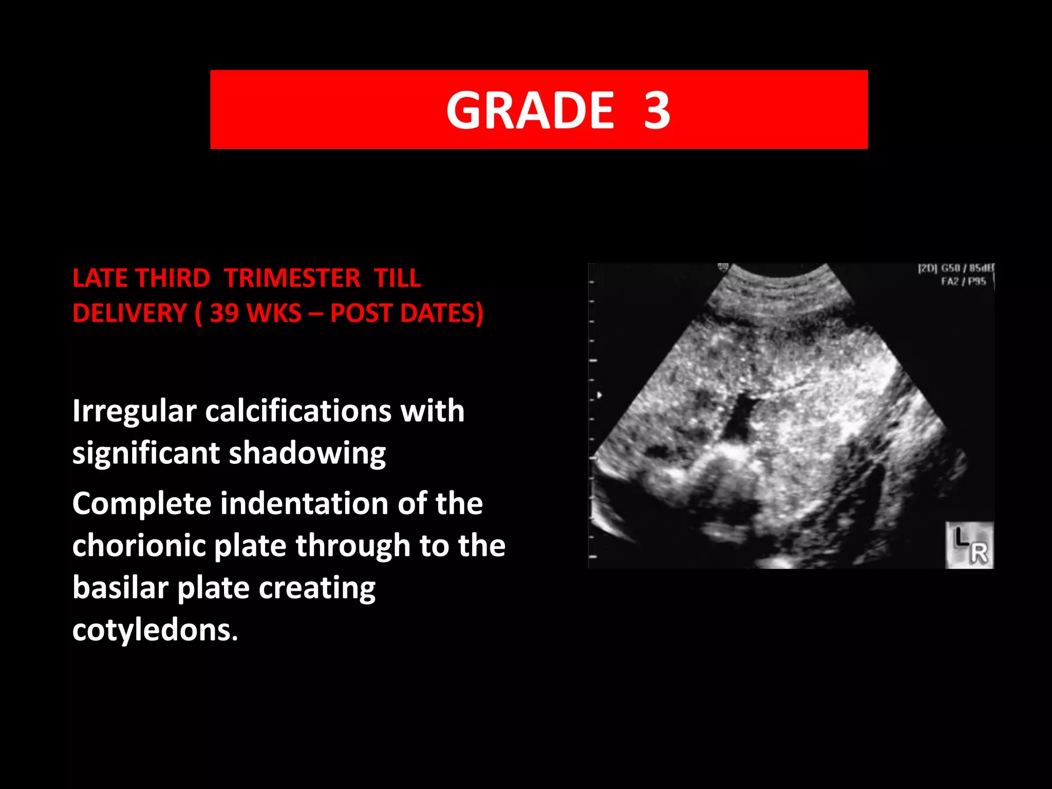    GRADE  3LATE THIRD  TRIMESTER  TILL DELIVERY ( 39 WKS – POST DATES)Irregular calcifications with significant shadowingComplete indentation of the chorionic plate through to the basilar plate creating cotyledons.
