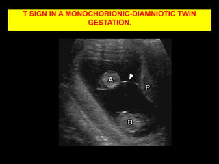 PLACENTA MEMBRANACEA.                                                                                                                                        THIN MEMBERANOUS PLACENTA©2009 by Radiological Society of North America