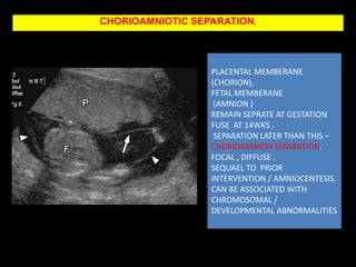 TWIN PEAK SIGN  DICHORIONIC-DIAMNIOTIC TWIN GESTATIONS.©2009 by Radiological Society of North America