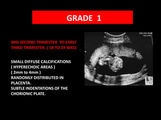 GRADE  1MID SECOND TRIMESTER  TO EARLY THIRD TRIMESTER. ( 18 TO 29 WKS)SMALL DIFFUSE CALCIFICATIONS                          ( HYPERECHOIC AREAS )                                      ( 2mm to 4mm )                                                 RANDOMLY DISTRIBUTED IN PLACENTA.                                                  SUBTLE INDENTATIONS OF THE CHORIONIC PLATE.                  