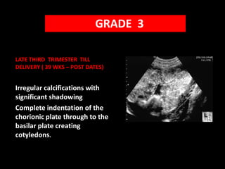    GRADE  3LATE THIRD  TRIMESTER  TILL DELIVERY ( 39 WKS – POST DATES)Irregular calcifications with significant shadowingComplete indentation of the chorionic plate through to the basilar plate creating cotyledons.