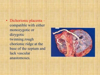 Chorionic Ridge Placental pathology | PPTX