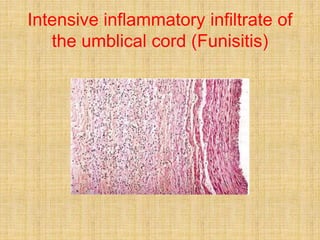 Funisitis Placental pathology | PPTX