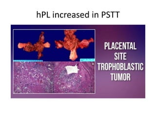 Pstt placenta ppt.pptx OBSTETRICS and gynaecologist | PPTX